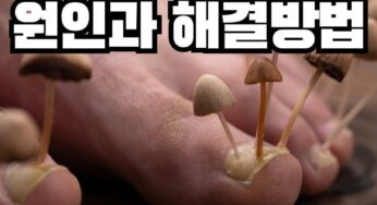 발톱 무좀의 비밀! 숨겨진 원인과 해결 방법