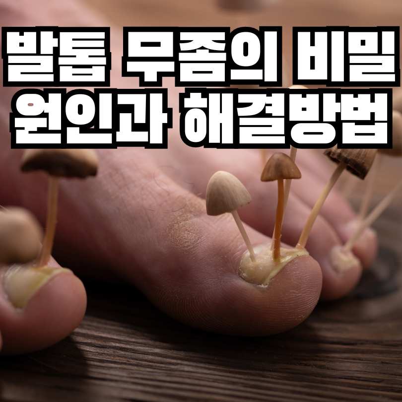 발톱 무좀